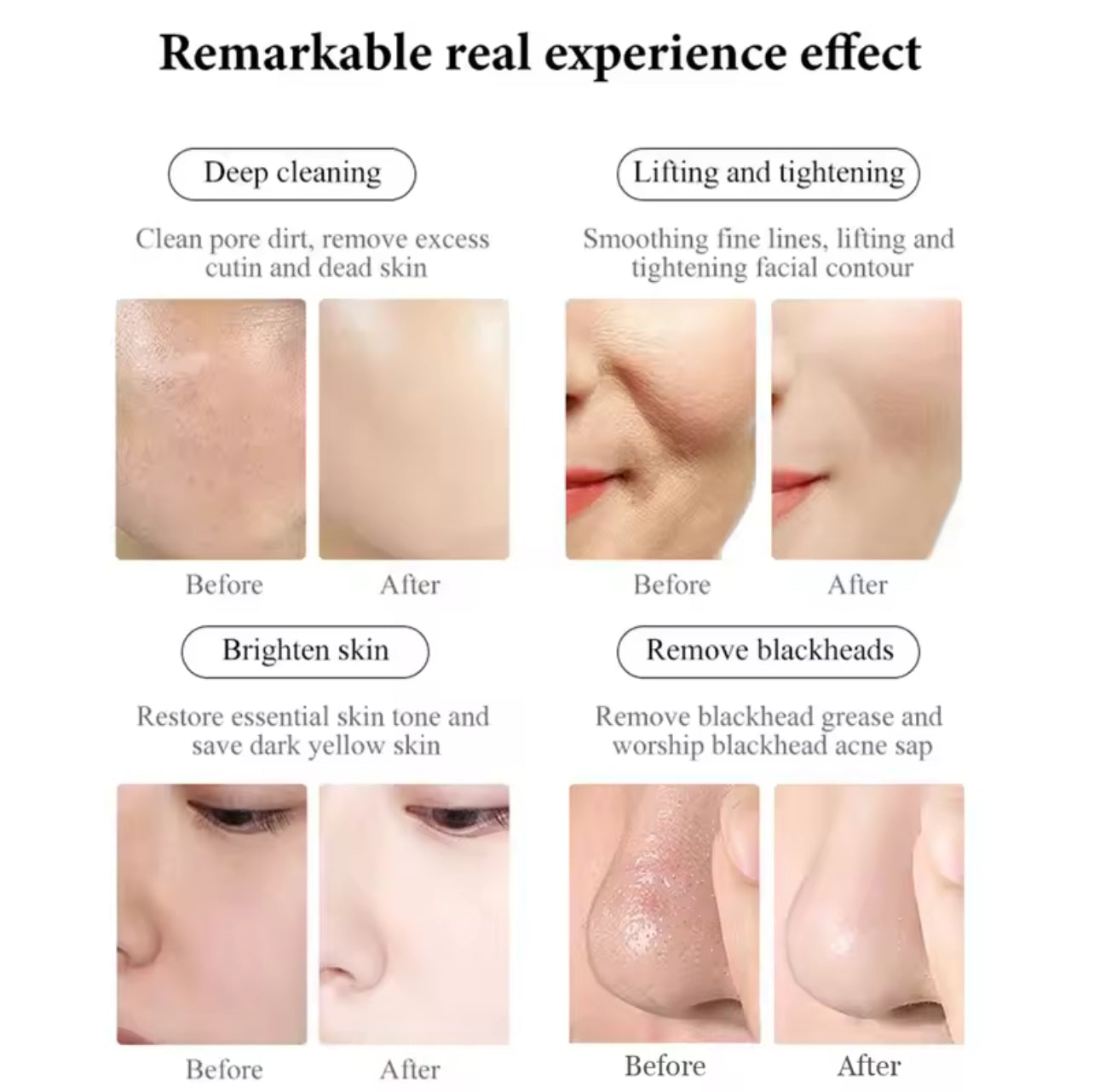 UltraWave Therapy with RF